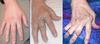 rheumatoid arthritis 1. stádium modern gyógyszerek glükózaminnal