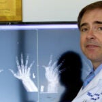 Filgotinib shows improvements in rheumatoid arthritis trial