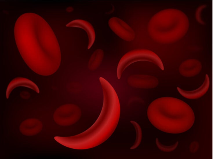 Global Blood Therapeutics leads in world sickle cell disease trials