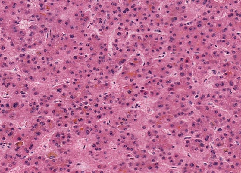 Tecentriq plus Avastin improves survival in Phase III liver cancer trial