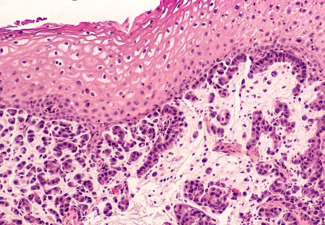 BeiGene’s Phase III tislelizumab for esophageal squamous cell carcinoma