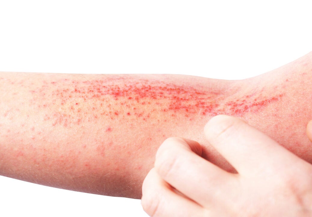 Aclaris’ topical JAK inhibitor in moderate-to-severe atopic dermatitis approval likelihood soars by 22 points