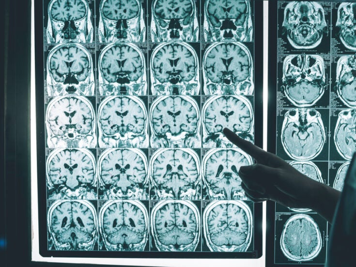 Alzheimer’s disease: how precision medicine could reverse cognitive decline