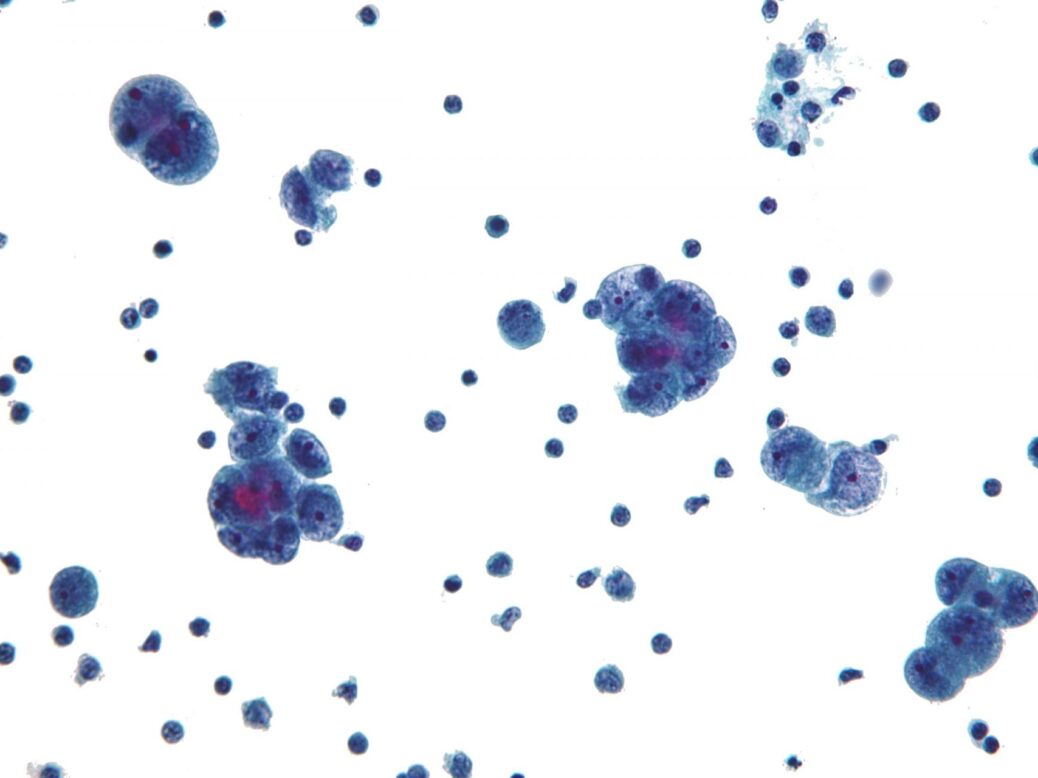 ICR says drug combo demonstrates effectiveness in ovarian cancer trial