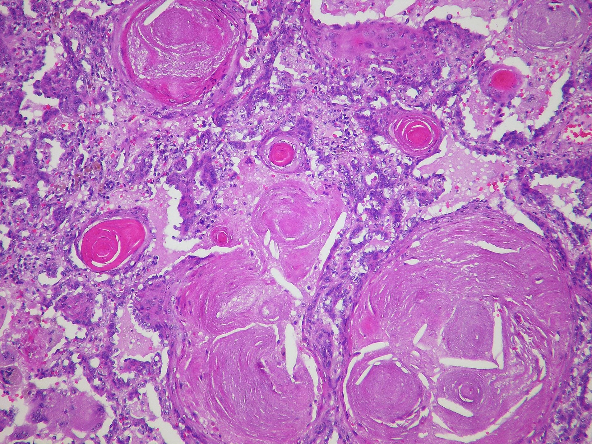 aveo-oncology-and-merck-partner-to-study-hnscc-combination-therapy