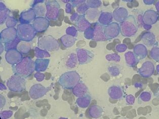 BioTheryX begins dosing in Phase I cancer trial