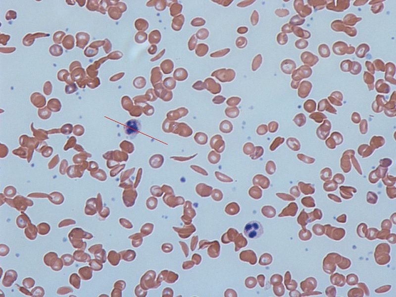 FDA; sickle cell