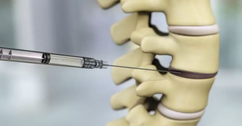 DiscGenics reports positive data from degenerative disc disease trial - Vimarsana News