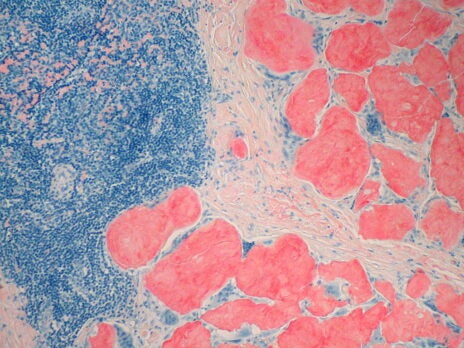 Intellia, Regeneron report positive Phase I transthyretin amyloidosis data