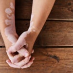 Vitiligo: all eyes on further Phase III data for Incyte’s ruxolitinib at AAD