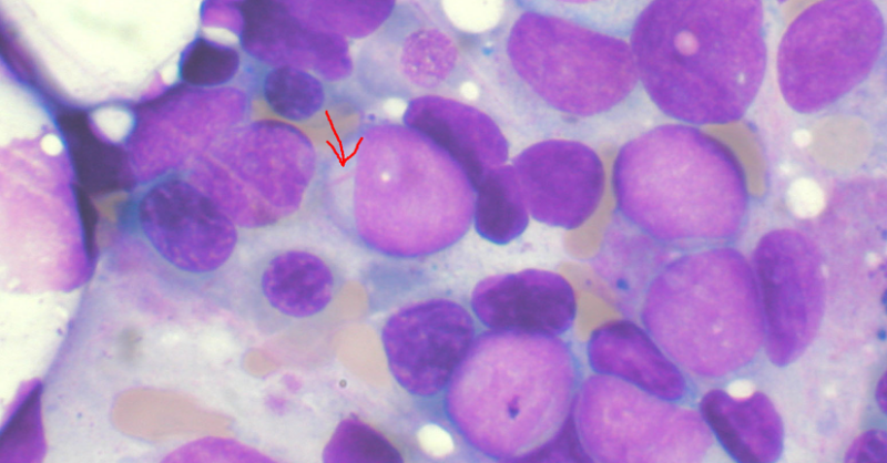 Priothera to start Phase IIb/III trial of acute myeloid leukaemia therapy - Vimarsana News