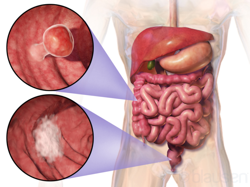 Isofol initiates data assessment in Phase III colorectal cancer drug trial - Vimarsana News