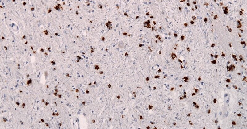 Alterity receives MHRA authorisation for Phase II trial of MSA therapy - Vimarsana News