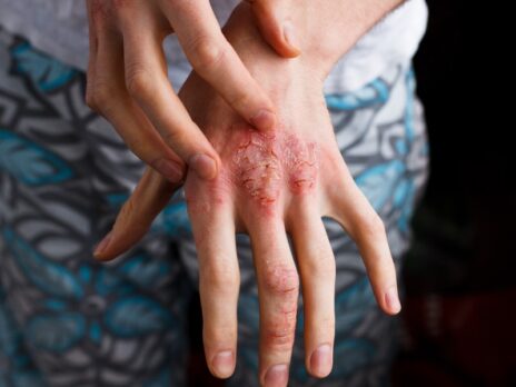 Risk of major depression increases by 60% in patients with atopic dermatitis