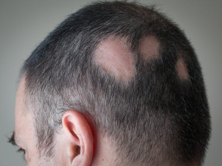 Alopecia areata steals the spotlight in time for possible treatment paradigm shift