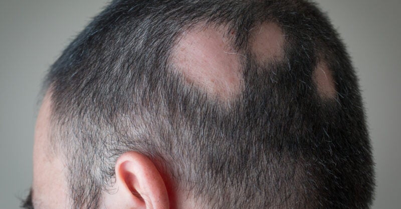 Alopecia areata in the spotlight in time for possible treatment paradigm shift - Vimarsana News