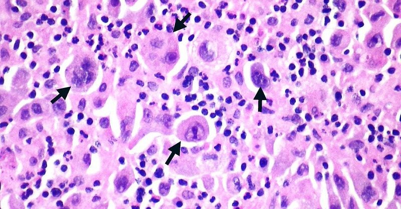 Baili and AstraZeneca partner to trial antibody for lung cancer - Vimarsana News