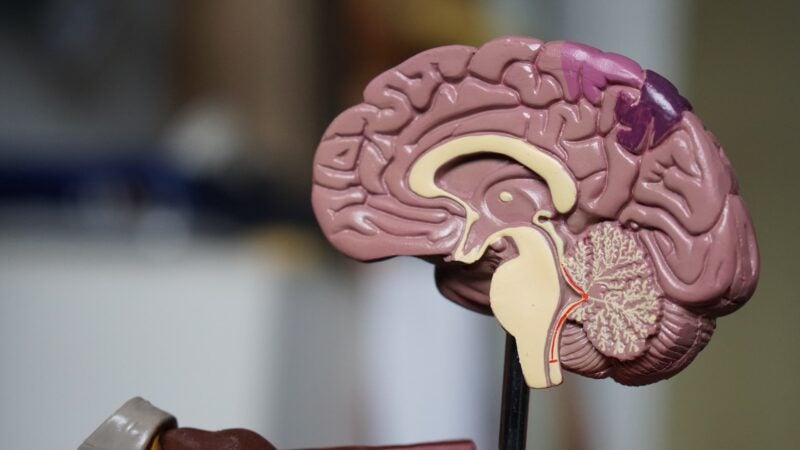 Kintara activates first European site of Phase II/III glioblastoma trial - Vimarsana News