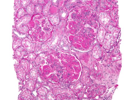 Kezar reports positive Phase II data of zetomipzomib for lupus nephritis