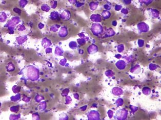 Calithera begins enrolment for Phase II B-cell lymphoma therapy trial
