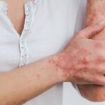 Soligenix gets FDA clearance for Phase II psoriasis trial