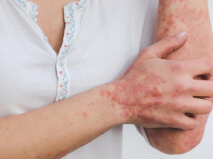 Soligenix gets FDA clearance for Phase II psoriasis trial