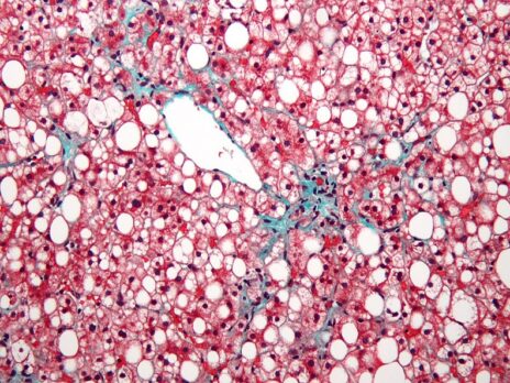 MediciNova begins Phase II non-alcoholic fatty liver disease trial