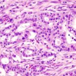 CG doses first patient in Phase Ib/II pancreatic adenocarcinoma therapy trial