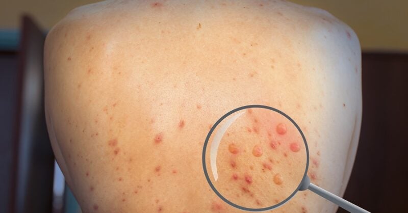 Monkeypox outbreak poses increased risk for 417,000 men who have sex with men - Vimarsana News