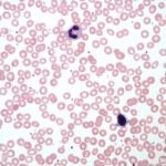 Graphite Bio doses first subject in Phase I/II sickle cell disease trial