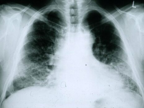 Pliant to progress Phase IIa idiopathic pulmonary fibrosis treatment trial
