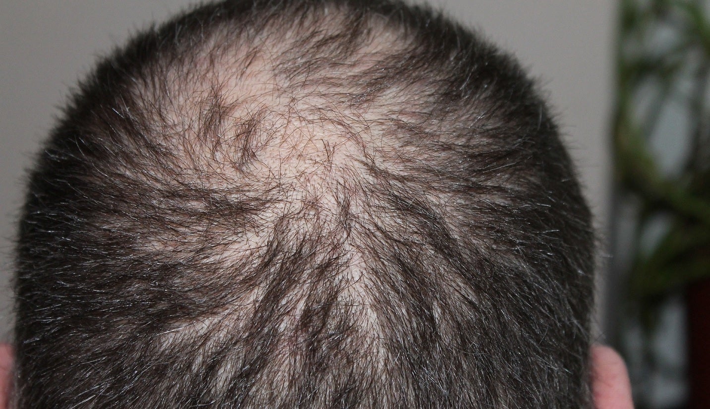 Kintor reports positive data from trial of androgenetic alopecia