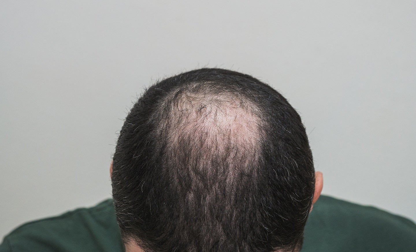 What Hair Loss Treatments Can Help With Androgenic Alopecia