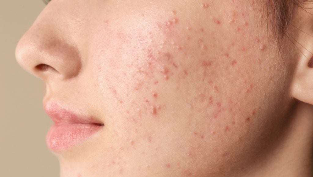 Ascletis reports positive results in Phase III denifanstat trial for acne