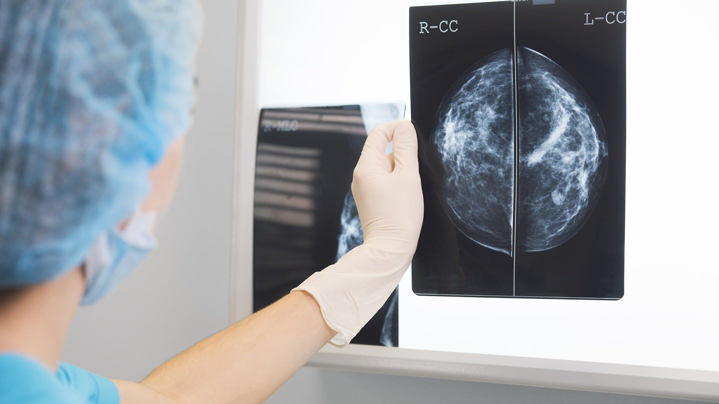 MEDSIR reports PHERGain and PHERGain-2 trial results for breast cancer