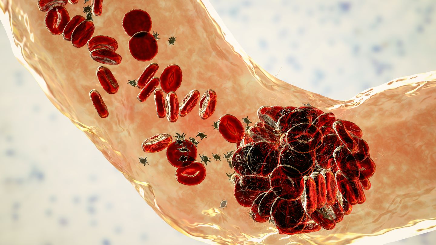 Jupiter Endovascular’s pulmonary embolectomy system hits primary endpoints in trial