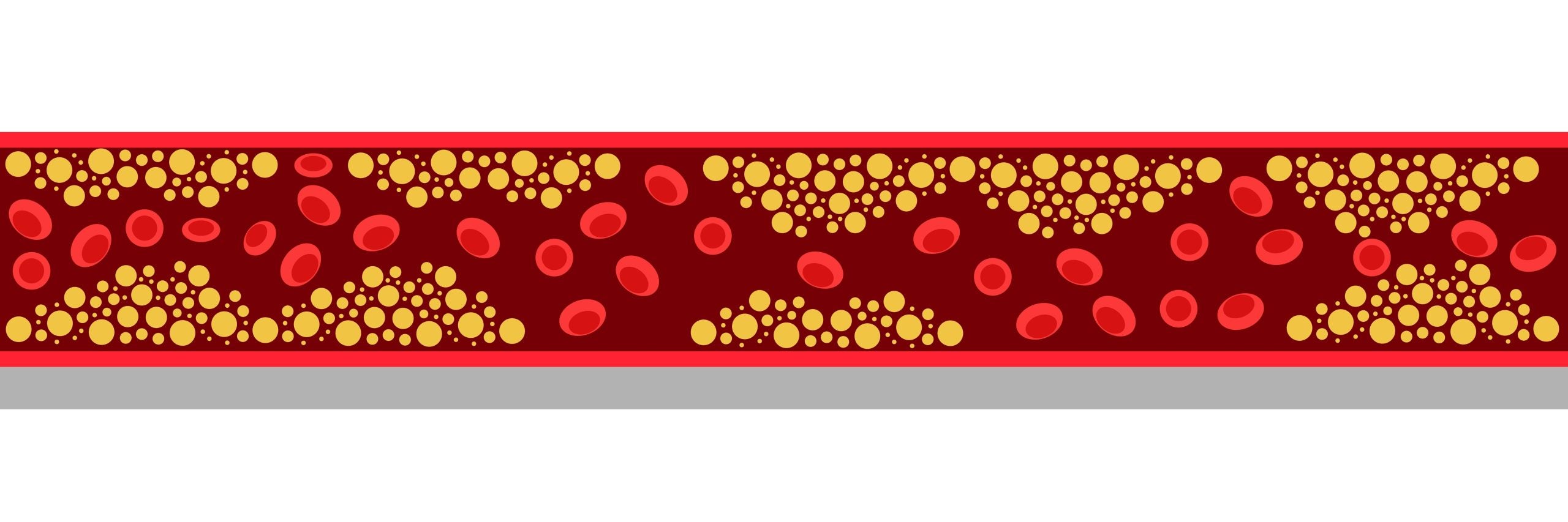 Tryngolza shows efficacy in severe hypertriglyceridemia as approval verdicts loom