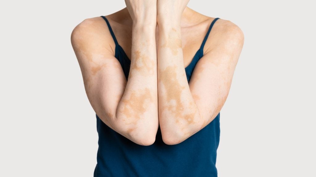 Forte Biosciences reports positive results from Phase Ib trial for vitiligo