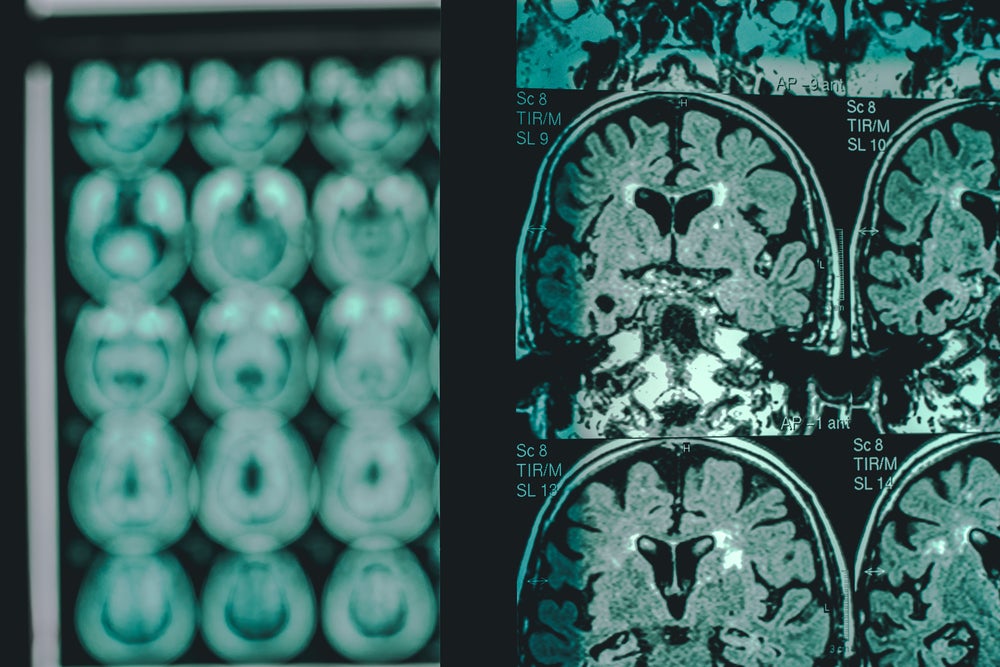AAIC26: Roche charts expanded course for Alzheimer’s therapy, touts long-term anti-amyloid impact