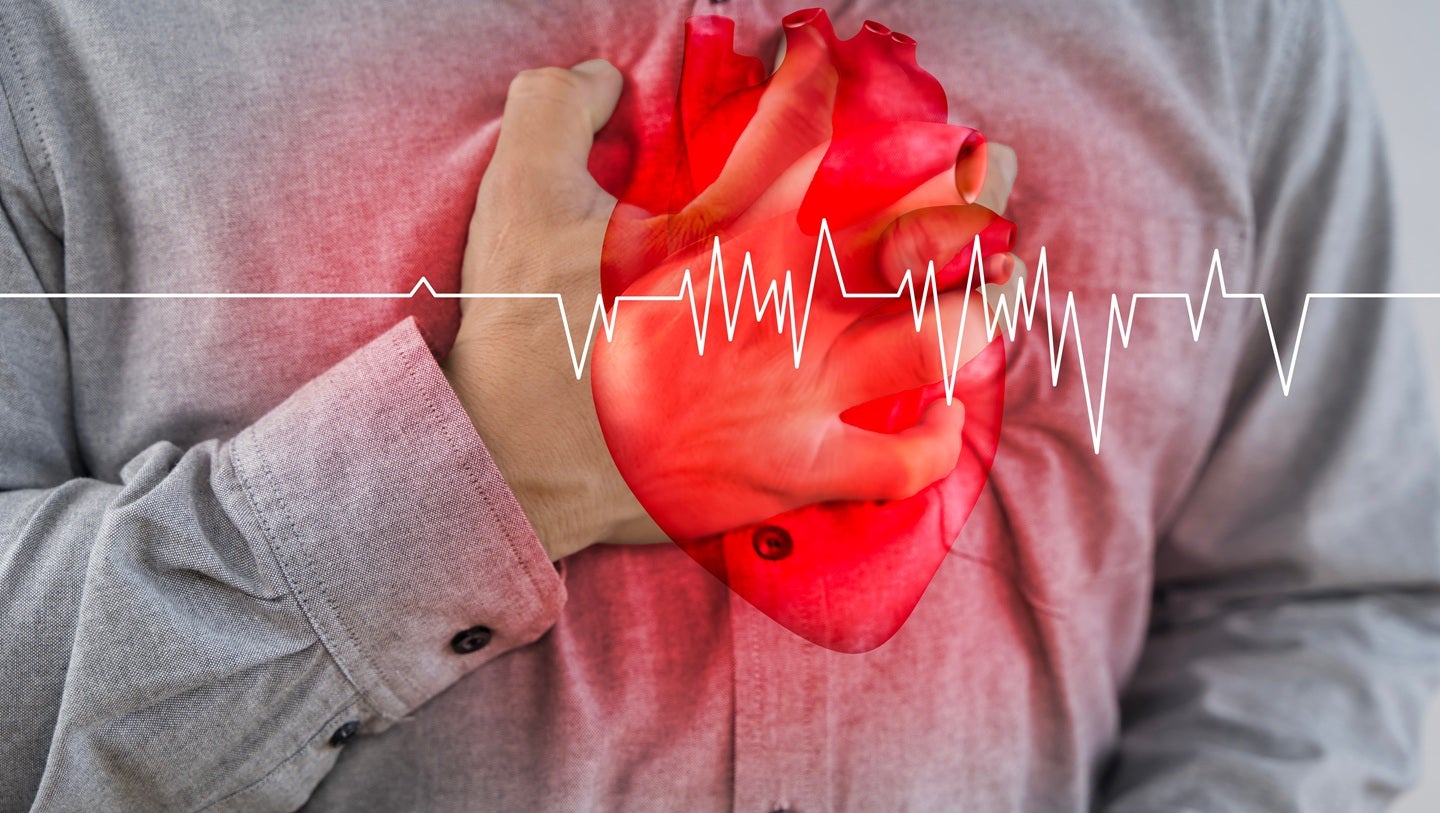 Milestone’s etripamil nasal spray enters Phase III trial for atrial fibrillation