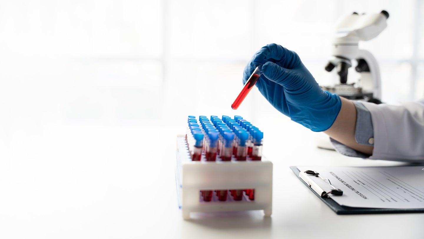 Fate Therapeutics begins Phase II trial of FT819 for lupus nephritis