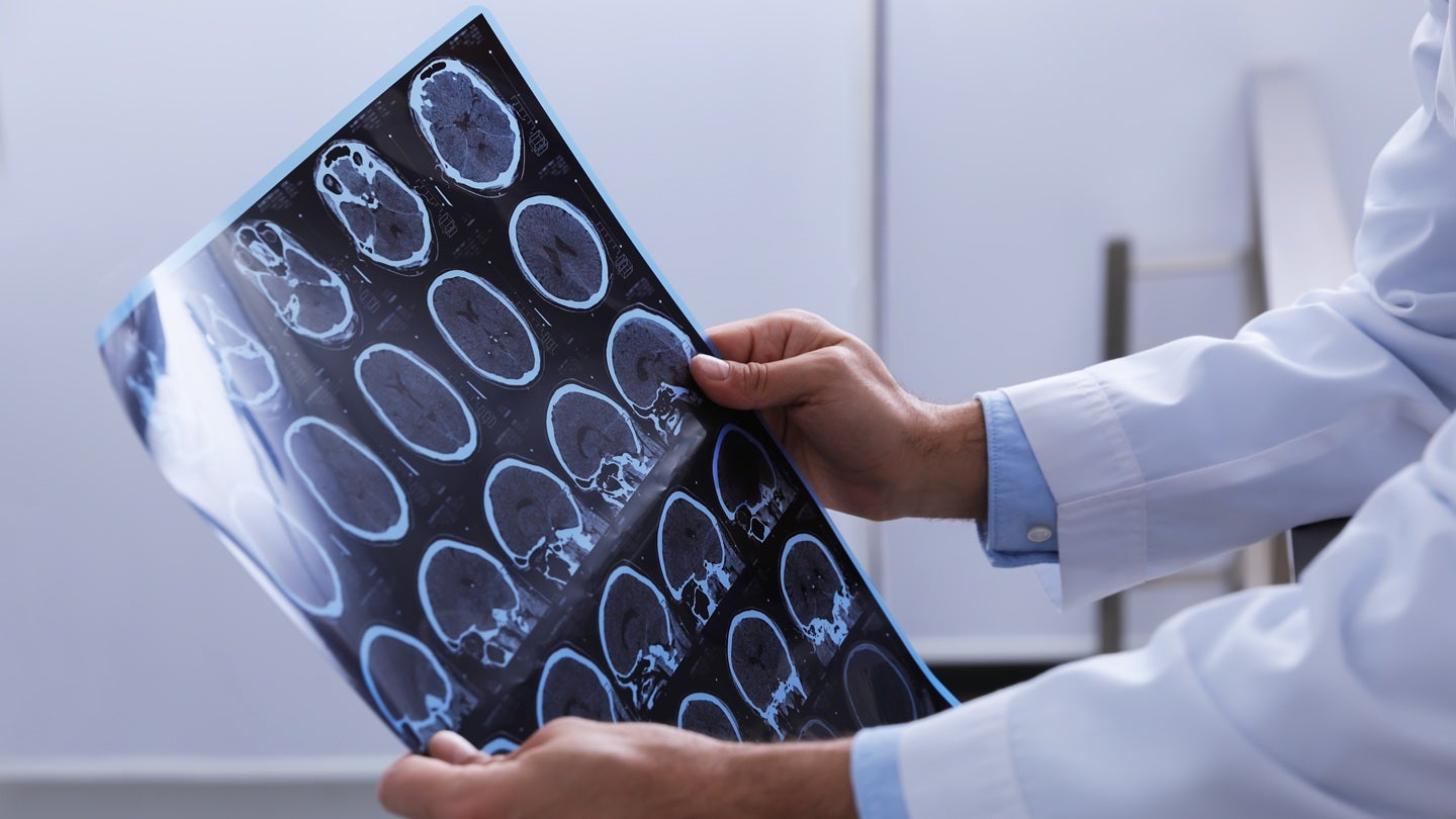 Novartis reports positive Phase III results for remibrutinib in RMS