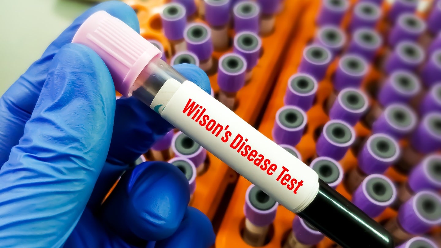 Orphalan launches Phase III TRADITiONAL trial for Wilson disease