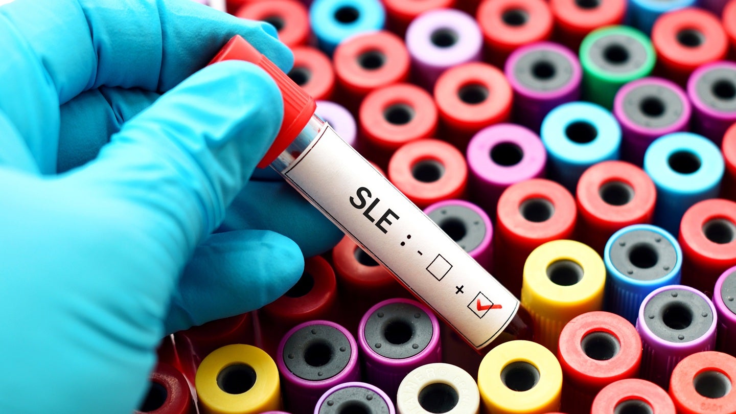 Beeline Medicines’ Phase II SLE trial of afimetoran meets primary endpoint